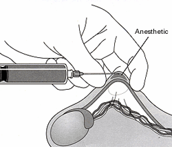 Local Anesthesia