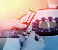PRP Therapy